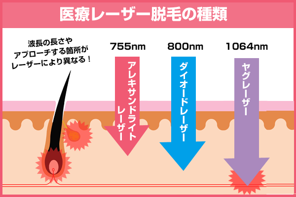 ワキ脱毛おすすめ医療クリニック サロン5選 必要回数 期間 料金で比較紹介 脱毛マガジン