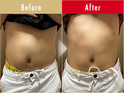 ビフォーアフター（お腹）1