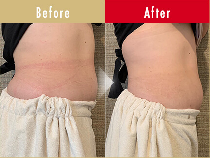 ビフォーアフター写真（お腹）3
