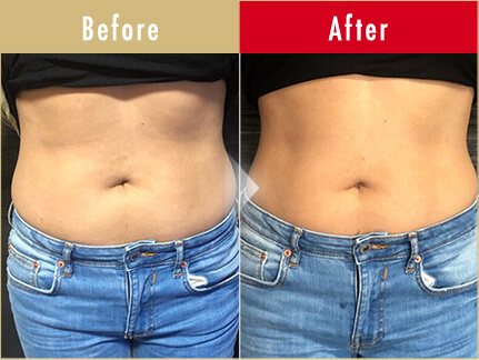 ビフォーアフター写真（お腹）9