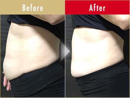 ビフォーアフター写真（お腹）12