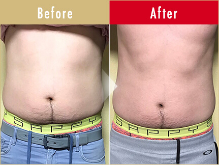 ビフォーアフター写真（お腹）4