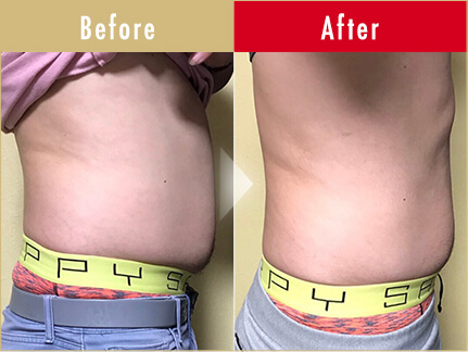 ビフォーアフター写真（お腹）5