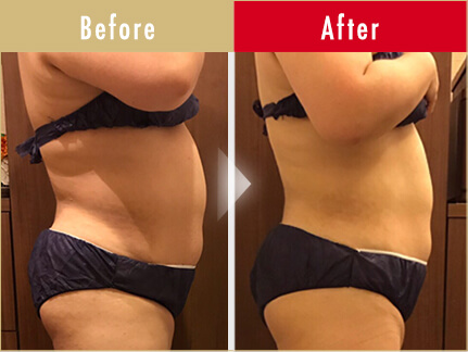 ビフォーアフター写真（お腹）16