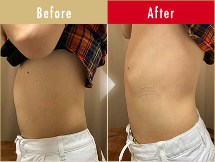 ビフォーアフター写真(お腹)2