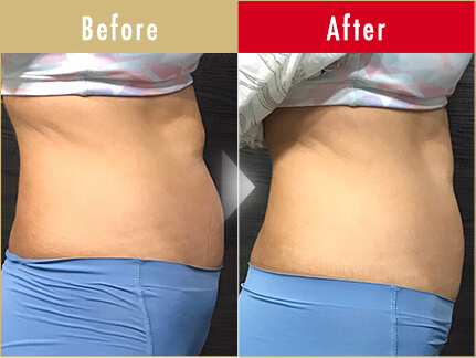 ビフォーアフター写真(お腹)6