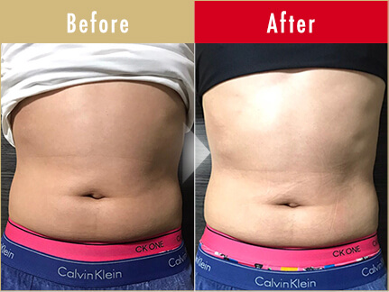 ビフォーアフター写真(お腹)7