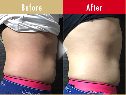 ビフォーアフター写真(お腹)8