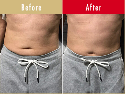 ビフォーアフター写真(お腹)10