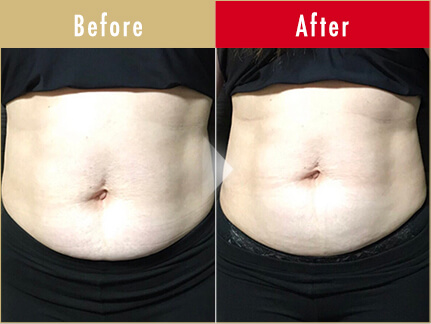 ビフォーアフター写真(お腹)11