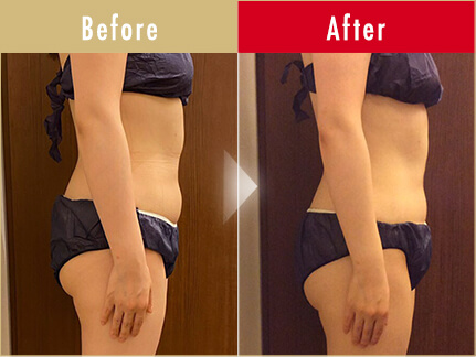ビフォーアフター写真(お腹)13