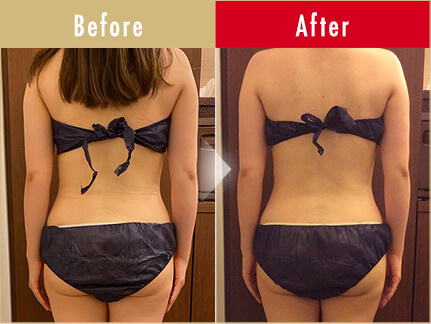 ビフォーアフター写真(お腹)14