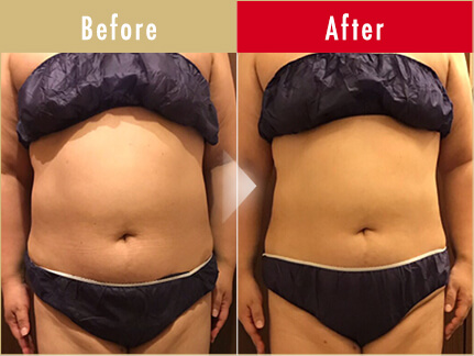 ビフォーアフター写真(お腹)15